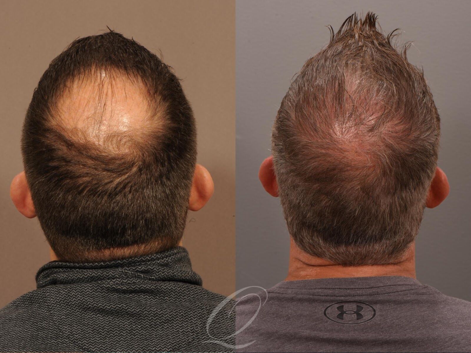 Why Get a Hair Transplant & How to Choose a Clinic in Fort Lauderdale